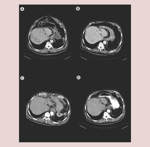 Figure 2.  Computerized tomography scan images of insulinoma lesions at different moments of the disease.(A) Basal. (B) 3 months after selective internal radiation therapy. (C) 6 months after selective internal radiation therapy. (D) A year after selective internal radiation therapy. A complete response is shown with no evidence of tumoral lesions. Concurrently with the radiological response, the hormonal syndrome disappeared.