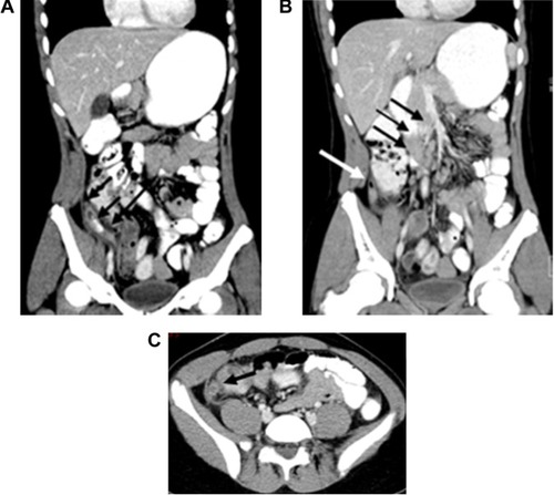 Figure 1 Preoperative postcontrast abdominal–pelvic CT scan of a child aged 14 years, who presented with abdominal pain and vomiting (PAS score =5).