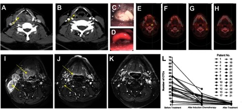 Figure 3 Imaging examination of regressing tumor in LAHNSCC patients after treatment. (A and B) CT images of tumor before and after induction chemotherapy (IC). After IC, the tumor occupying the hypopharyngeal cavity had shrunk (B). The yellow arrow indicates the tumor location. (C and D) Laryngoscope images of the same patient as in A and B before IC and after surgery (Sx) and radiotherapy (RT). Before IC, the tumor was occupying the hypopharyngeal cavity (C). After Sx and RT, the tumor was cut and edema was improved (D). (E and F) PET-CT images shows that the hypermetabolism region at left tonsil before IC as shown in E disappeared after IC (F). (G and H) PET-CT images shows that the hypermetabolism region at the left swollen lymph node before IC (G) was still there after IC as shown in H. (I and K) MRI images of tumor before IC, after IC, and after RT, showing that the swollen left lymph nodes as indicated by the yellow arrow in I had regressed after IC (J). After RT, the swollen lymph node disappeared (K). (L) CTC enumeration before treatment, after induction therapy, and after treatment. All patients had reduced CTCs after induction therapy, and CTCs decreased even more when the treatment was completed.Abbreviations: LAHNSCC, locally advanced head and neck squamous cell carcinoma; CTC, circulating tumor cells.