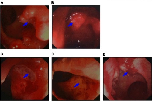 Figure 1 Results of colonoscopy. (A) Colonoscopy showed an ulcer-like neoplasm situated 6 cm from the anal margin with a little bleeding, covering half of the lumen in September 2011 (arrows). (B) The re-examination of colonoscopy showed an ulcer type neoplasm on dentate line with erosion, which was brittle and subjected to hemorrhage, covering half of the lumen in November 2011 (arrows). (C) In February 2012, the re-examination of colonoscopy, which showed a 2 × 2 cm2 ulcer on distal rectal wall (near the dentate line) with white tongue coating (arrows). (D) In August 2012, the colonoscopy showed a scar with smooth surface on distal rectal wall (near the dentate line, arrows). (E) In March 2013, the colonoscopy showed a 2 cm × 4 cm neoplasm on the dentate line with erosion, which was brittle and subjected to hemorrhage (arrows).