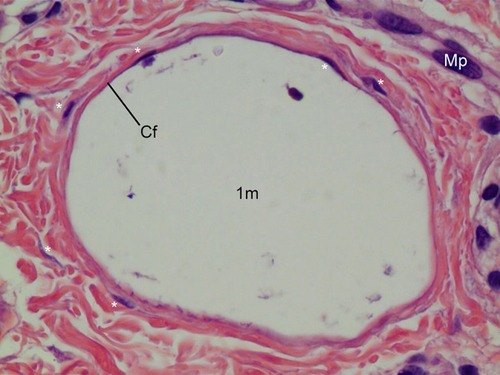 Figure 6 CaHA particle (1 m) in Figure 5 with 400× magnification. The large size particle was likely injected recently and particle might be injected 1 month before the biopsy. The particle was not surrounded by giant cells or macrophages (Mp), only fibroblasts (*) as shown here. This CaHA particle (1 m) was surrounded by five fibroblasts, which may have contributed newly made thin collagen fibers (Cf), even at 1 month post injection.