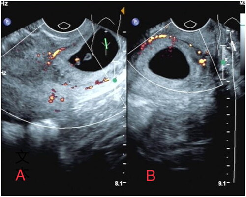 Figure 1. Ultrasound images obtained from a patient with CP. A. A sagittal of a gestational sac in the cervix. B. Transverse view of a gestational sac in the cervix.