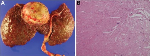 Figure 4 Macroscopic aspect and microscopic examination of liver specimen. Grossly, the liver showed macronodular cirrhotic change and a yellow necrotic mass (6.3 × 5.6 cm) at segment 4/8 (A). Microscopic examination showed complete necrosis of the hepatocellular carcinoma (B, hematoxylin and eosin, 100×).