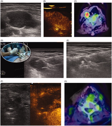 Figure 2. Dual-fiber laser ablation for primary hyperparathyroidism. (A) A 65-year-old female presented with increasing bone pain and arthralgia, increased parathormone levels and hypercalcemia. A 2.0 × 1.3 cm adenoma was identified at gray scale ultrasound caudal to the thyroid. (B) Contrast enhanced ultrasound demonstrated a heterogeneously enhancing nodule. (C) Baseline Tc-99 Sestamibi is highly positive (red color). (D) Intraprocedural gray scale ultrasound demonstrated the placement of two laser fibers spaced 1 cm apart inserted into the gland. (E) Increased echogenicity is identified surrounding the fibers during the active application of laser energy. Normalization of parathormone and calcium levels occurred by 6 months. (F) Two-year follow-up gray scale and contrast enhanced ultrasound demonstrate a non-enhancing 0.9 × 0.7 cm gland. (G) Tc-99 Sestamibi shows no evidence for increased uptake.