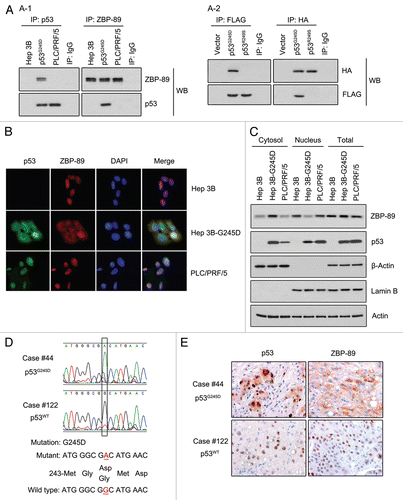 Figure 3 p53G245D interacts with ZBP-89 and retains it in cytoplasm. (A) p53G245D directly bound to ZBP-89. (A-1) Hep3B cells were transfected with pcDNA 3.1-p53G245D or pcDNA 3.1 for 24 h and then selected by antibiotic G418 for another 21 d to establish a stable cell line which was named Hep3B-G245D. Total proteins of Hep3B, Hep3B-G245D, PLC/PRF/5 cells were extracted by RIPA plus protease cocktail and incubated with a primary antibody that recognizes ZBP-89 or p53 mutants. After being incubated overnight at 4°C, the protein-antibody complex was deposited by Protein A/G-agarose. The whole complex was boiled and then subjected to western blot to examine the interaction between ZBP-89 and p53 mutants. (A-2) p53G245D and p53R249S tagged with HA, and ZBP-89 fused to FLAG plasmids were transfected into Hep3B cells. The immunoprecipitated FLAG-ZBP-89 complexes were separated on a sodium dodecyl sulfate-polyacrylamide electrophoresis gel, transferred to membrane and immunoblotted with anti-FLAG or anti-HA antibody. IgG was served as a negative control for antibodies used in immunoprecipitation. (B) p53G245D co-localized with ZBP-89 in cytoplasm. Hep3B, Hep3B-G245D, PLC/PRF/5 cells were fixed by 4% PFA and incubated with p53 and ZBP-89 antibodies overnight at 4°C. After staining with fluorescence secondary antibodies and DAPI, cells were observed under fluorescence microscope. (C) p53G245D affected the cellular localization of ZBP-89. Cytoplasmic and nuclear proteins were isolated. Levels of p53 and ZBP-89 in each fraction were detected. β-actin and Lamin B were used as the cytoplasmic and the nuclear markers, respectively. (D) p53G245D was identified in HCC tissues. DNAs extracted from HCC tissues were subjected to sequencing analysis. The sequencing diagram was shown. Nucleotide and amino acid sequences of both wild-type (case #122) and mutant p53 (case #44) were also presented. (E) ZBP-89 was found in cytoplasm in p53G245D-expressing samples. HCC tissues were fixed in 4% PFA and then subjected to immunohistochemistry to detect the expressions of p53 mutants and ZBP-89. The representative microphotographs of p53 and ZBP-89 immunohistochemical staining in HCC tissues were shown (original magnification, 400x).