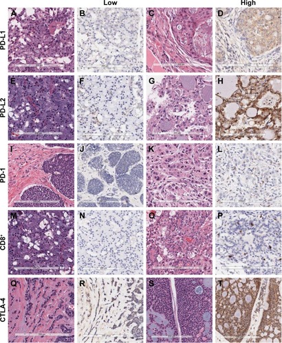 Figure 1 Representative examples of hematoxylin and eosin staining and immunohistochemical staining for PD-L1, PD-L2, PD-1, CD8+ tumor-infiltrating lymphocytes, and CTLA-4 in malignant salivary gland tumors (×200).