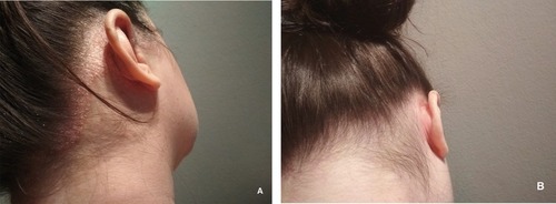 Figure 1 Case 1: (A) before and (B) after treatment for 4 weeks with calcipotriol (50 µg/g)/betamethasone dipropionate (0.5 mg/g) aerosol foam.