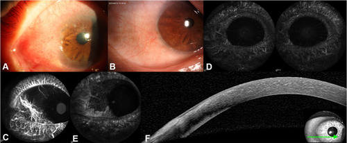 Figure 2 Three-year follow-up of case 3, a 57-year-old male patient with a primary diagnosis of ocular surface squamous neoplasia (OSSN) in the right eye at baseline (A). Anterior segment photography reveals a spot in the palpebral fissure between 8 and 9 o’clock, with a smooth and transparent cornea, and no recurrence of OSSN (B). Early-phase indocyanine green angiography (ICGA) visualizes a patch of non-perfusion in the palpebral fissure, with no intratumoral or conjunctival feeding vessels (C). Stereo pair-mode ICGA displaying a three-dimensional view of the entire anterior segment, with left and right polarization acquired in parallel (D). Late-phase ICGA also reveals the patch of non-perfusion (E). Anterior segment optical coherence tomography (AS-OCT; F) displays normal corneal structures at the original OSSN location (green arrow indicates the direction of AS-OCT scanning).