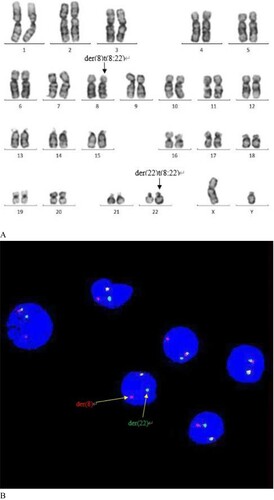 Figure 2. (A) Chromosome analysis by G banding showing inserted karyotype of 46,XY,t(8;22) (p11;q11) in 20 out of 20 metaphases with no other abnormal karyotytes in this patient. (B) The fusion signal is observed in the patient by FISH. nuc ish (FGFR1×2)(5′FGFR1 sep 3′FGFR1×1)[384/400].