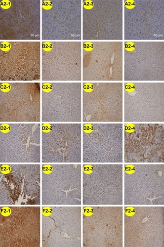Figure 16 Representative SATB1, Wnt1, β-catenin, E-cadherin, vimentin, and SNAIL expression in liver metastases of nude mouse model assessed by immunohistochemistry.