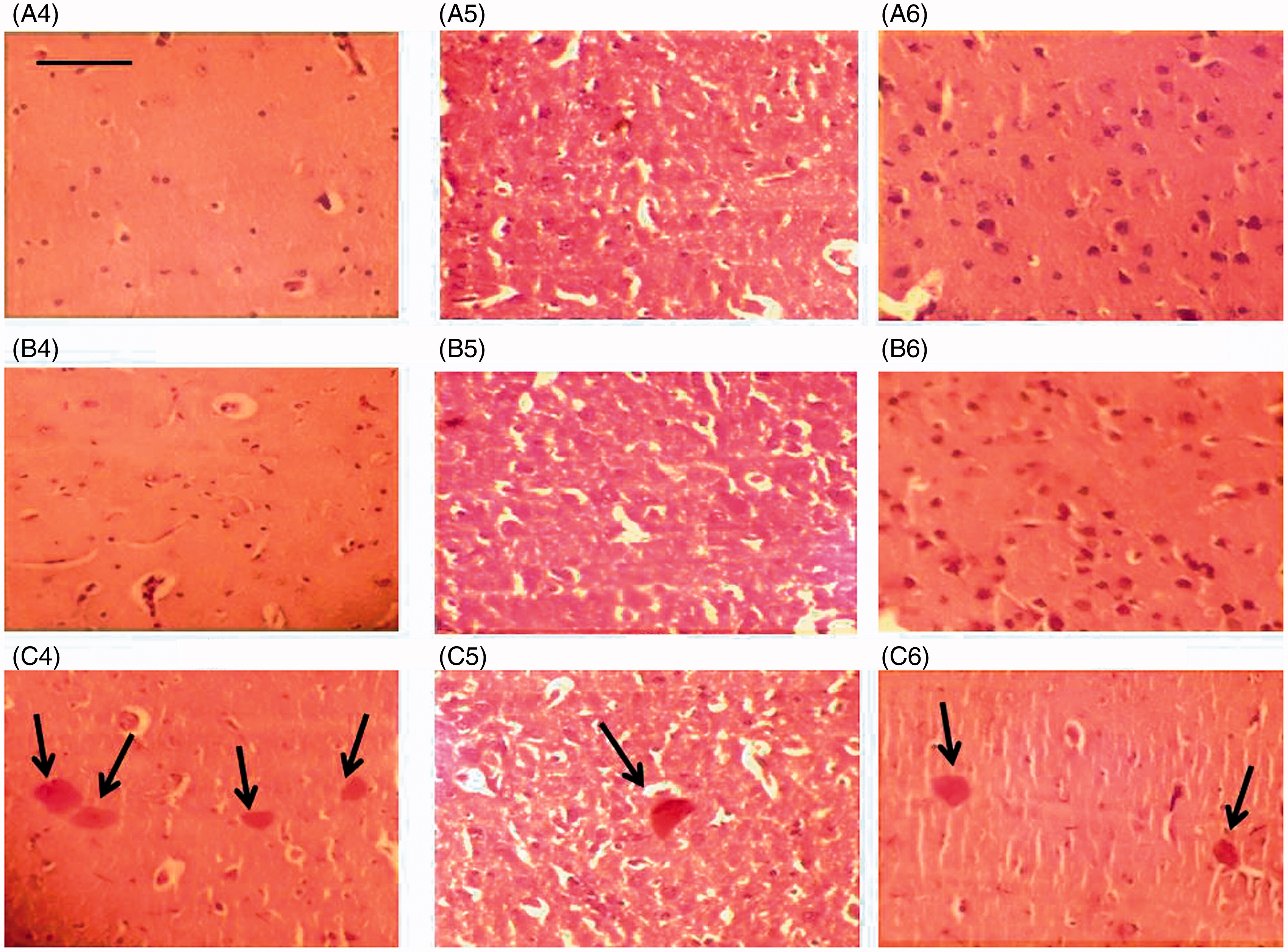 Figure 5. Staining (Congo red) of plaques in different brain areas in rats. Representative micrographs are shown. Control rats: (A) (top row); sham-operated rats: (B) (middle row); icv colchicine injected rats: (C) (last row). Hippocampus: 4 (left column), corpus striatum: 5 (middle column), amygdala: 6 (right column). Letter and number indicate group and specific brain region (e.g. A4: Hippocampus, control rat). Magnification: 400×, length of bar = 16.18 μm. Arrows indicate plaques.