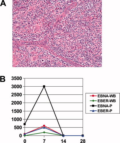 Figure 1.  (A) Image from December 2001 biopsy: The nodal architecture is effaced by a polymorphic cellular infiltrate, with a spectrum of lymphoid cells (including clusters of clear cells and scattered large atypical immunoblasts), as well as eosinophils and prominent vascular elements, with frequent arborizing vessels. Hematoxylin and eosin, original magnification ×200. (B) EBV PCR on peripheral blood. Both peripheral whole blood (WB) and plasma (P) were subjected to EBV quantitative real-time PCR utilizing primer sets against EBV encoded RNA (EBER) and EBNA on days 0, 7, 14, and 28 of bexarotene (Viracor-IBT Laboratories, Lee’s Summit, MO).