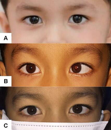 Figure 2 Example case 1 of AACE: (A) photo prior to onset, (B) photo of deviation prior to treatment and (C) photo after surgical intervention.