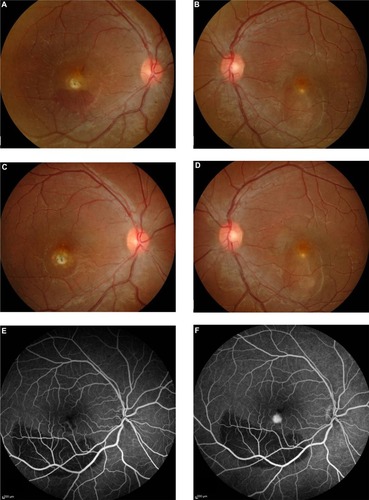 Figure 1 (A–H) Case 1. Color fundus photograph of the right eye at presentation, showing submacular hemorrhage and a yellowish fibrotic nodule (A). Color fundus photograph of the left eye, showing a dome-shaped elevation at the foveal region with the presence of yellowish deposits (B). Fundoscopy of the right eye, showing resolved subretinal hemorrhage with residual scarring at the foveal region at 2 months posttreatment (C). Fundoscopy of the left eye, showing similar findings to those at presentation (D). Fundus fluorescein angiogram, showing increased hyperfluorescence at the macula, consistent with choroidal neovascularization (E early phase, F late phase). Optical coherence tomography of the right eye at presentation, showing a subretinal pigment epithelium fibrotic nodule with a subretinal reflection of a subfoveal choroidal neovascularization and surrounding subretinal fluid (G). Optical coherence tomography of the right eye at 2 months posttreatment, showing resolution of the subretinal fluid at the right macula (H). Green lines indicate the cross-section of the macula shown by the adjacent optical coherence tomography image.