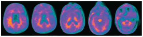 FIGURE 2. 18F-florbetaben PET imaging. Uptake tracer in white matter is generally higher than in gray matter. In left parietal and right superior temporal lobes, tracer uptake is similar in white and gray matter.