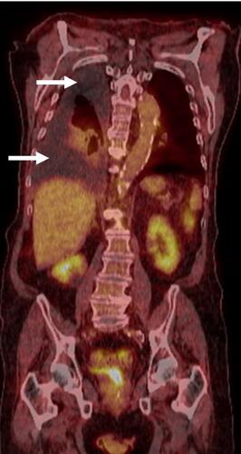 Figure 2 PET scan demonstrated no abnormal FDG processes throughout the body. Large right-sided pleural effusion was present, but without any hypermetabolic activity (arrows).
