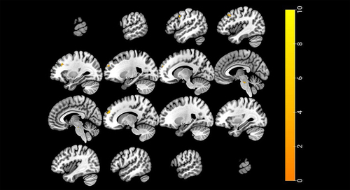 Figure 4 The association between activation to sleep-related sound in right anterior cingulate cortex and Cognitive Appraisal of Sleep. Relative BOLD response was calculated by subtracting BOLD response to NS from the one to SS.