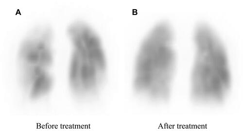 Figure 2 Lung perfusion scintigraphy before treatment (A) and after treatment (B).