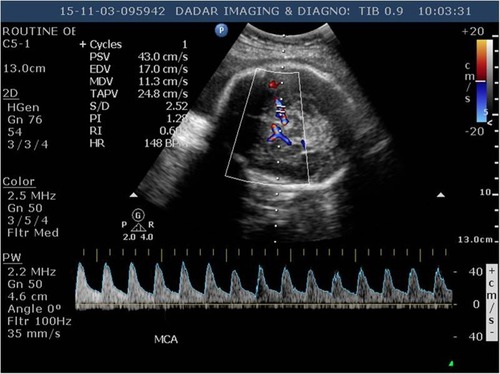 Figure 5 Doppler of umbilical artery showing normalization of systolic/diastolic ratio (2.52) after starting sildenafil citrate.