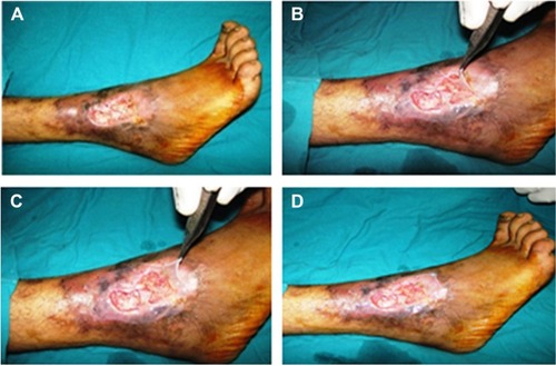 Figure 2 Amniotic membrane application over two leg ulcers.