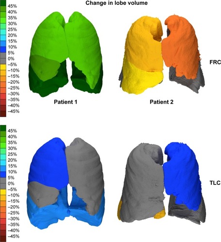 Figure 5 FRI images of 2 patients displaying the changes in lobar volume. The scale represents the percent change in the volume of the different airway branches at the different lung levels; green represents an improvement, while red represents a worsening.