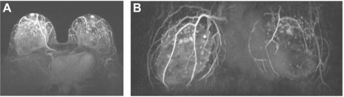 Figure 2 Maximum intensity projection post-processing three-dimensional magnetic resonance angiographic images on axial (A) and coronal (B) views.