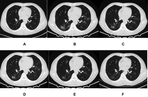 Figure 3 A 44-year-old man who exposed to COVID-19 patient has fever, cough, and diarrhea for 4 days. The initial chest CT is negative (A). After 7 days, the first repeat CT shows multiple spherical and patchy GGOs with heterogeneous density developed in the bilateral lungs (B). Subsequently, the lesions directly absorb with decrease of extent and temporary increase of density (C–E). On the latest CT scan (29 days later), they significantly absorb and leave a small amount of faint GGO (F).