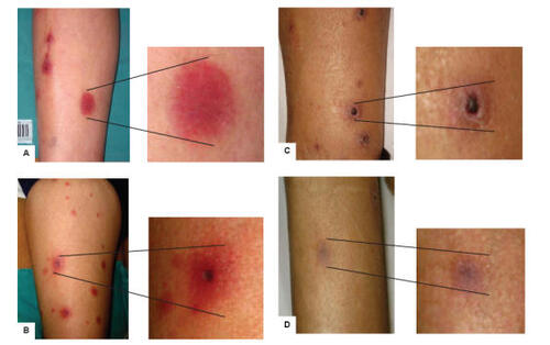 Figure 1 Patient with disseminated fusariosis and skin involvement. The lesions are seen most commonly on extremities and appear as widespread, violaceous (A) or erythematous indurated elements (B). With the resolution of the infection the skin lesions become darker (C) and the lesions disappear (D).