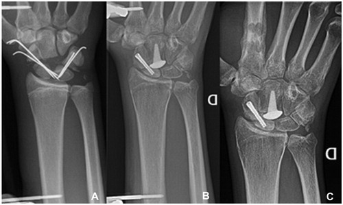 Figure 2. (A) X-ray after the first surgery. Note the empty space at the place of the proximal pole of the capitate. (B) X-ray after the second surgery, the K-wires were replaced by the RCPI prosthesis and a screw was inserted in the scaphoid. (C) At 21 months’ follow-up (all case 1).