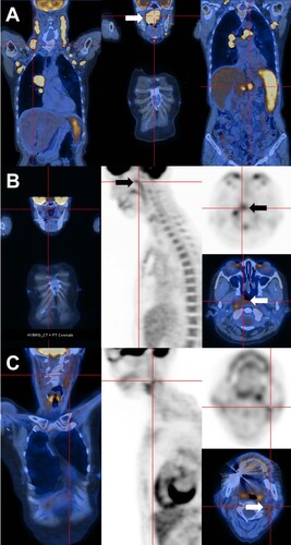 Figure 1. Positron emission tomography computed tomography. (A) On presentation, showing disseminated hypermetabolic lymphadenopathy, pulmonary lesions, a huge nasopharyngeal mass (arrow), and splenomegaly with abdominal lymphadenopathy. (B) End-of-treatment, showing residual nasopharyngeal mass of reduced size and metabolic activity (arrows). (C) After four 21-day cycles of lenalidomide, with complete resolution of the nasopharyngeal mass. There was some residual lymphadenopathy (arrow) with metabolic activity lower than that of the liver.