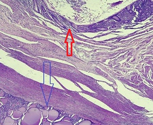 Figure 7 Inset view of the appendix (red arrow) and the periphery of the tumor deposit (blue arrow).