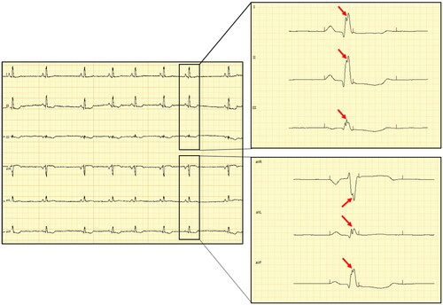 Figure 1. Electrocardiographic tracing of a dog with fQRS: left – figure of the 6-lead electrocardiographic tracing calibrated at 10 mm/mV and 50 mm/sec; right – selected captions during interpretation of fragmented QRS calibrated at 200 mm/sec and 20 mm/mV – note the slurring in the peak of the R-wave characterized as a double-peaked R-wave (red arrows) in all six limb leads (leads I, II and III in the upper-right corner and aVR, aVL and aVF in the lower-right corner).