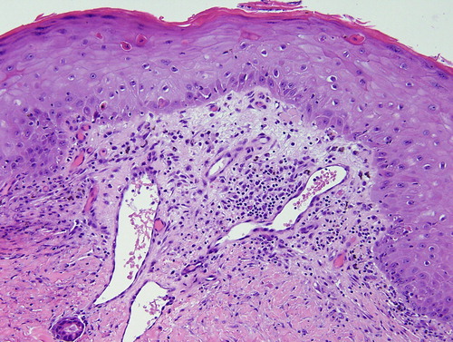 Figure 2. A higher power view illustrating dyskeratotic cells scattered throughout the epidermis with occasional adjacent lymphocytes.