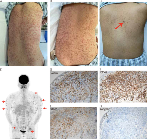 Figure 1 (A–C) Skin condition before and after treatment. Upon admission, multiple yellowish-red or reddish-brown papules and nodules almost spread throughout the body, with clear boundaries and partial fusion. The back area was the most severe (A). After the completion of 4 courses of CHOP+ lenalidomide, the rash subsided significantly, with significant pigmentation on the back (B). Two courses of chemotherapy were completed after recurrence, and the rash almost completely subsided with only a small amount of pigmentation on the back (red arrow, biopsy scar after recurrence) (C). (D) [18F] FDG-PET/CT showed considerable metabolic increases in the skin (the red arrows point to some areas exhibiting heightened metabolic activity). Areas including the upper limbs (upper arm), lower neck, body (back), and the skin/subcutaneous area of the upper thighs of both sides within the detection range, and some of them were accompanied by small nodular shadows. The possibility of malignant tumor lesions was considered. Immunohistochemical studies demonstrated that the histiocytes were positive for CD1a (E), CD68 (F) and S-100 (G) and negative for Langerin (H).