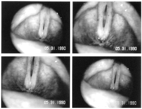 Figure 5 Endoscopic pictures of the vocal folds of a 58 year old woman during phonation, who presents with bowing of the vocal folds, thinning lamina propria and a persistent glottal chink.