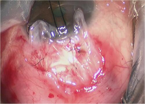 Figure 1 Amniotic membrane above the scleral flap (stromal surface facing down).