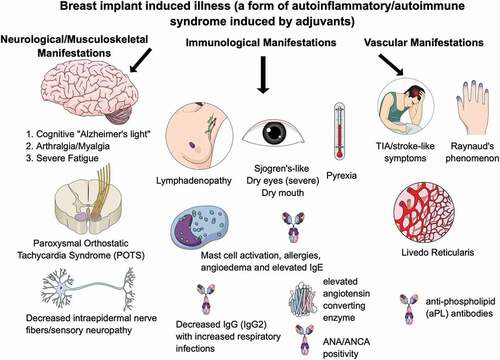 Figure 1. Breast implant illness (a form of autoimmune/autoinflammatory syndrome induced by adjuvants) presents with neurological/musculoskeletal, immunological, and/or vascular manifestations.