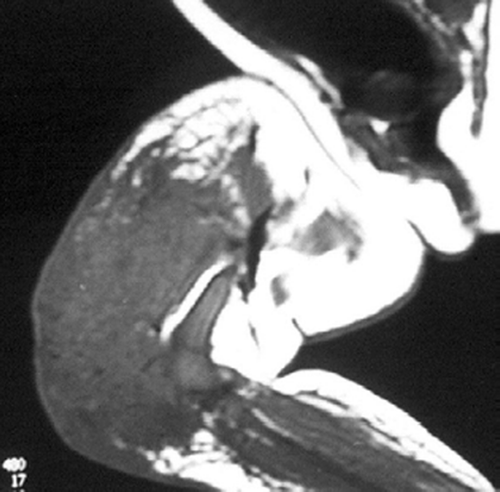 Figure 3. MRI showing circumferential mass in quadriceps and lateral hamstrings with homogenous density.