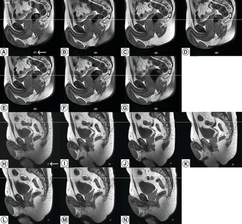 Figure 5. MRI of both volunteers.Serial MR images of the same sagittal slice after repositioning of a volunteer in the immobilization device, during 40 min period. All images shared the same DICOM coordinates. One MR marker is visible on each image (bottom). The dotted line is a visual support for the craniocaudal displacement.DICOM: Digital imaging and communications in medicine; MR: Magnetic resonance.