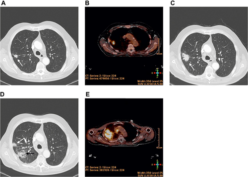 Figure 8 SUVmax persistence associated with radiation pneumonitis (see Figure 3). (A and B): 80-year-old patient with histologically confirmed non-small cell lung carcinoma (white arrow). CT (size 14 mm) and PET/CT (SUVmax = 7.56) at the time of diagnosis. Therapy was rejected. (C): Follow-up 1 year later, enlarging tumour mass (increase in size to 39 mm, white arrow). SBRT was performed (9 Gy in 5 fractions, total dose 45.0 Gy). (D): Follow-up 1 month later with radiological radiation pneumonitis (black arrow) and tumour response (white arrow, size 6 mm). (E): Increasing consolidation on CT at 3 months, suspect of relapse. PET/CT was performed (SUVmax = 8.27) and a biopsy was taken, but the histology was negative (no malignity). SUVmax persisted without evidence of a recurrent tumour. Radiation pneumonitis was diagnosed. (paratracheal increased metabolic activity with histologically confirmed lymph node metastasis, once again radiotherapy was performed).