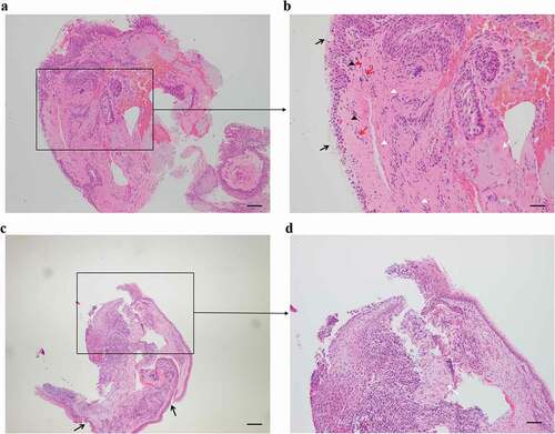 Figure 2. Hematoxylin-eosin staining of the biopsies (a and b zoom in insert). The typical histopathology of the pterygium. (b insert) shows an increase in goblet cells and epithelial hyperplasia of the conjunctiva (black arrows), invasion of new blood vessels (red arrows), hyperplasia of fibroblast cells (white triangles), stroma degeneration (white arrow), lymphocyte infiltration (red triangles) and neutrophils (black triangles). (c and d zoom in insert) Corneal tissue (c) with localized epithelial detachment and loss of the anterior elastic membrane (black arrows). (d insert) Fibrous degeneration of the superficial stroma with infiltration of inflammatory cells (white arrow) and a large infiltration of inflammatory cells in the deep stroma. Scale bar = 200 μm.