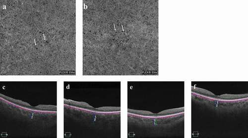 Figure 3. (a–b) OCTA showed diffuse ischemia per se (white arrows) on the choriocapillaris OU at presentation. (c–d) The choroidal thickness of the subfovea increased to 519 μm OD and 608 μm OS at presentation and (e–f) then decreased to 352 μm OD and 365 μm OS three months later.