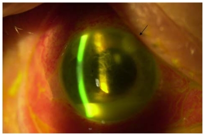 Figure 1 Slit lamp photograph on postoperative day 10 showing keratitis and endophthalmitis.