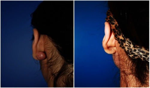 Figure 4 Auricular keloid. Before and after treatment result at 2-year follow-up.