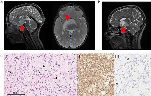 Figure 1. MR images and histology. (a) T2 weighted MR images in sagittal (left) and axial planes (right), just before initiation of first chemotherapy treatment (October 2009). Arrows are pointing at the tumor. Blue lines indicate the position of the corresponding plane. (b) MR image April 2018, 3 months before surgery. (c) [I] Hematoxylin and eosin staining of tumor sections demonstrate a biphasic pattern with compact (+) and dominating loose (*) areas. Tumor cells are well differentiated and have astrocytic morphology. In compact areas elongated bipolar cells with fine terminal processes (arrows) are seen. In loose areas stellate cells are common (arrowhead). [II] GFAP immunostaining was strong, and [III] Ki-67 proliferation labeling index was low (1.2–2.4%). Scale bar represents 100 µm