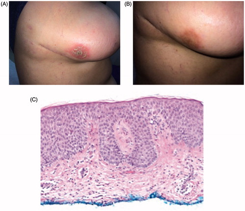 Figure 3. Clinical features before and after therapy with fluocinonide ointment, and histopathologic features of nummular eczema (Case 3). (A) Erythematous, scaly, crusted plaque on the right lateral inferior breast. (B) Therapy results three months after fluocinonide 0.05% ointment treatment. (C) Hematoxylin–Eosin biopsy section showing spongiotic dermatitis with eosinophils at x10 magnification.