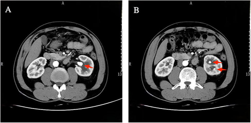 Figure 1 Preoperative CT images. (A) Showing calculi (red arrow) in the left pelvis. (B) Showing multiple calculi (red arrows) in lower calyx at a transverse plane.