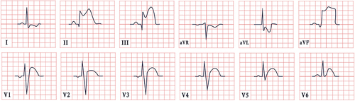 Figure 2 ECG features in Kounis syndrome, demonstrating sinus rhythm, normal cardiac axis, diffuse coved and saddleback ST elevations in leads II, III, aVF and ST segment depression in leads I and aVL.
