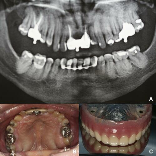 Figure 10 Panoramic radiograph after the O-rings installation (A). Occlusal view of the tree O-rings installed (B). Inner surface of the denture with the attachments placed on position (C).