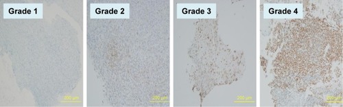 Figure 5 Expression of CA IX in patient osteosarcoma tissue samples.